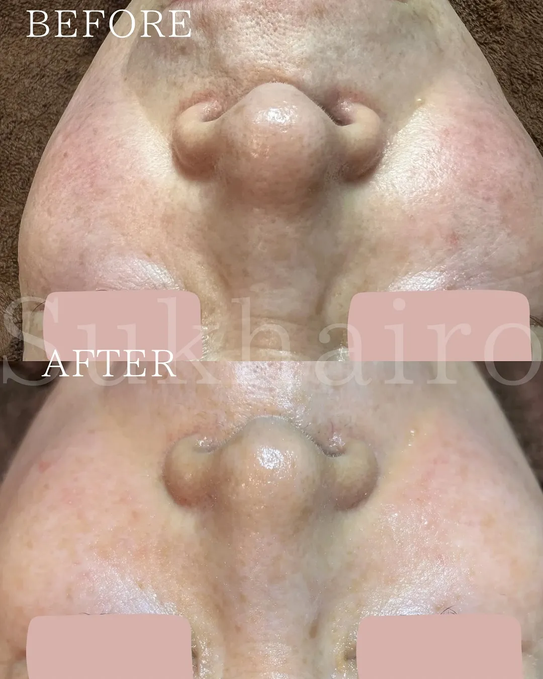 数ヶ月前からスタートしている#ホワイトスノーピール 💎